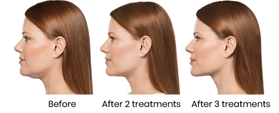 Kybella before after