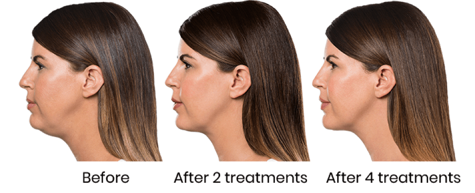 Kybella before after
